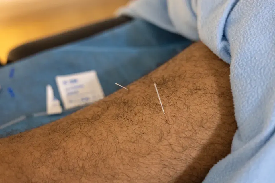 Close-up of dry needling treatment